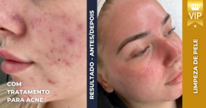 tratamento para acne, como acabar com a acne, causas da acne